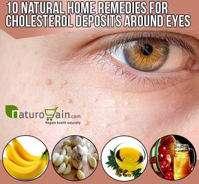 10 Natural Home Remedies for Cholesterol Deposits Around Eyes