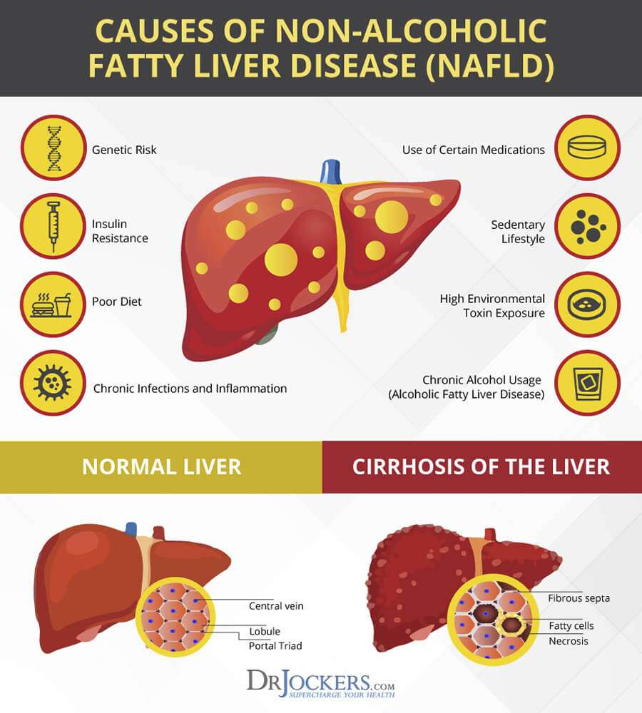 12 Strategies to Heal Fatty Liver Naturally