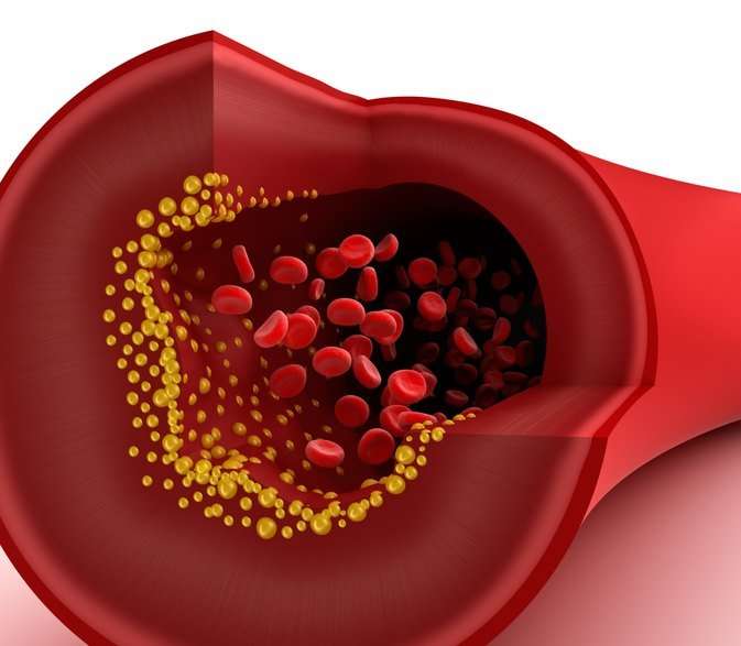Can You Have Blocked Arteries With Low Cholesterol ...