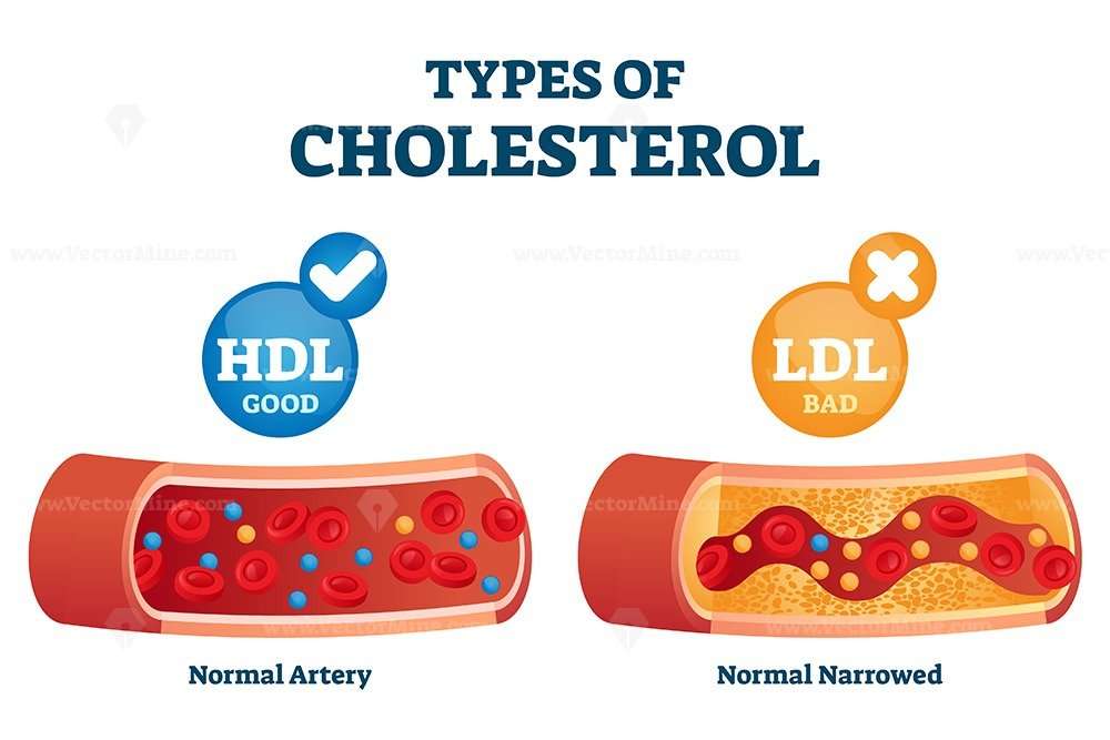 Cholesterol types comparison with HDL and LDL lipoprotein ...