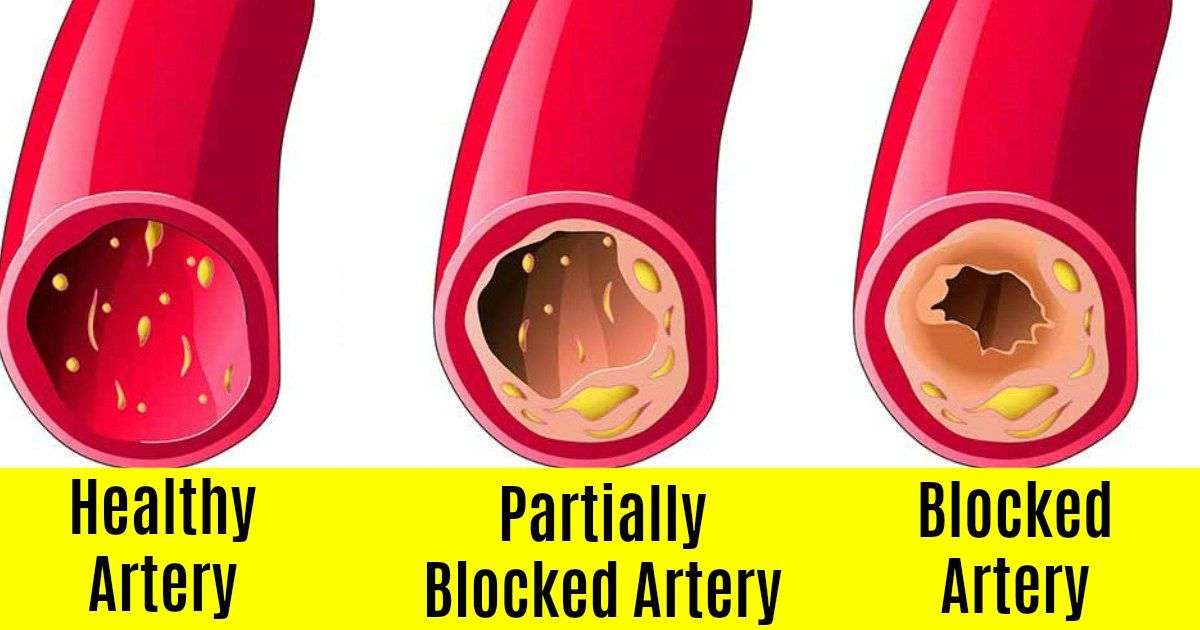 Clogged arteries are the leading cause of atherosclerosis and numerous ...