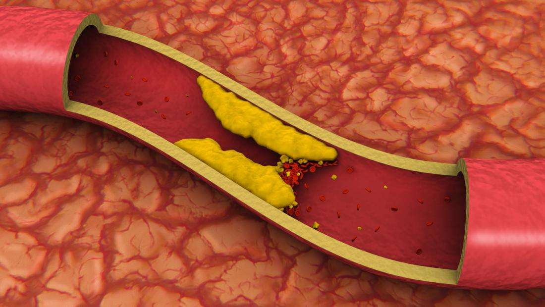 Clogged arteries may be down to bacteria, not diet