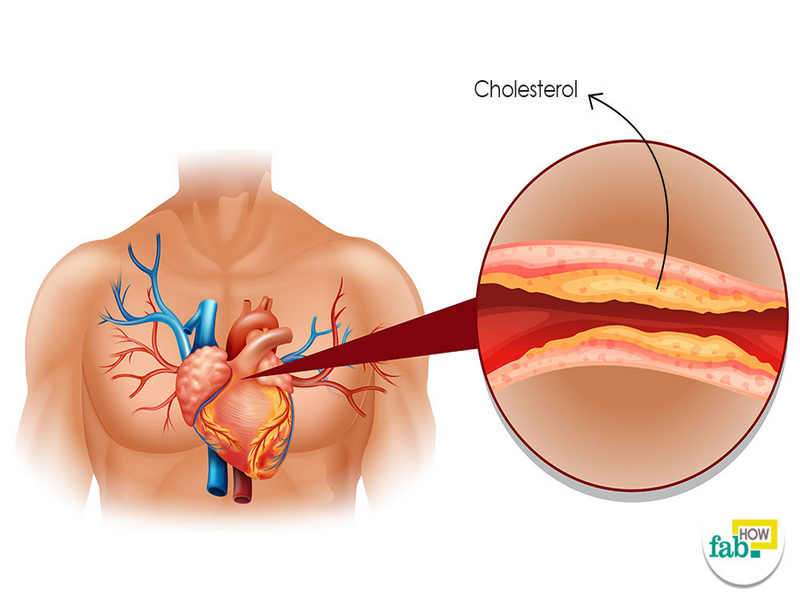 Does High Cholesterol Cause Headaches And Dizziness
