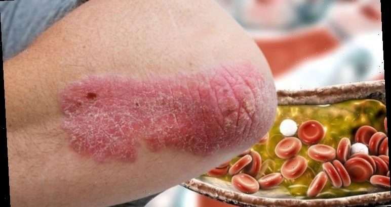 High cholesterol symptoms: Psoriasis on your skin may ...