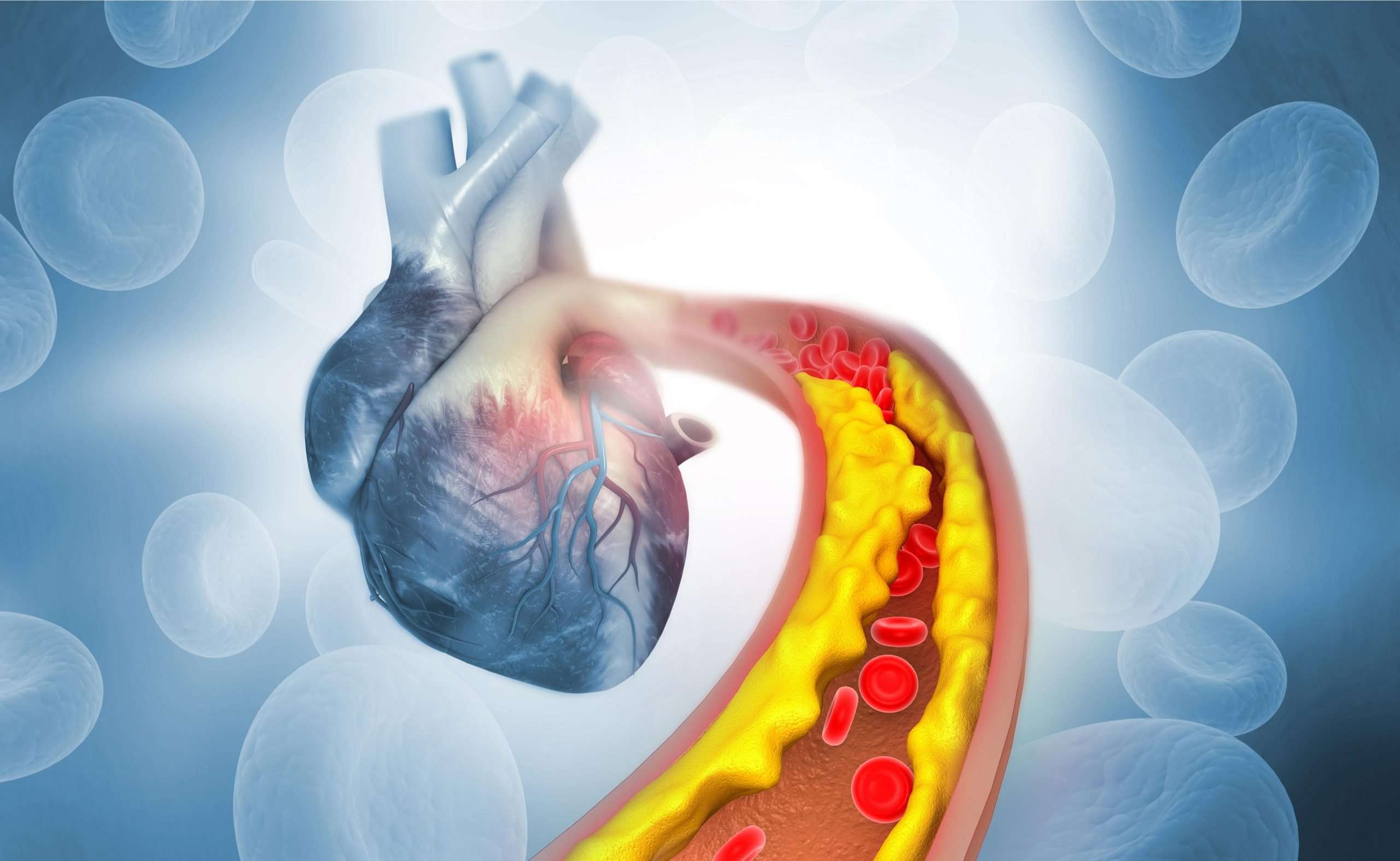 High cholesterol: what it means, what causes it and how to ...