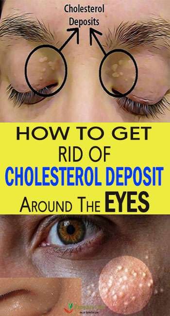 How To Get Rid Of Cholesterol Deposit Around The Eyes