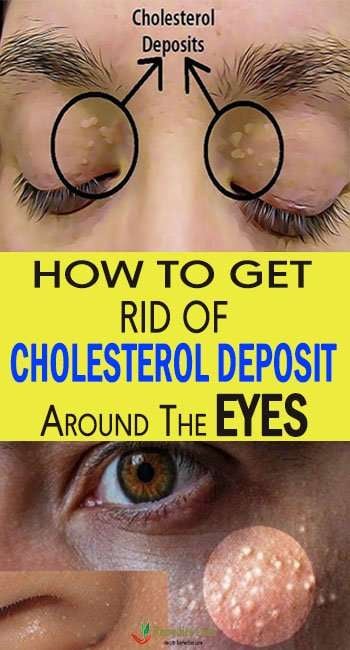 How To Get Rid Of Cholesterol Deposit Around The Eyes ...