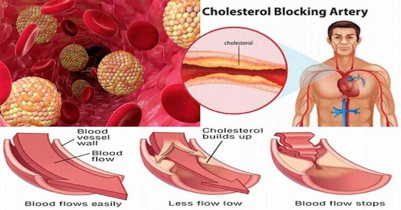 How to naturally REVERSE high cholesterol WITHOUT drugs or ...
