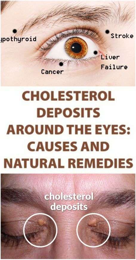 How to Remove the Cholesterol Deposits around the Eyes ...