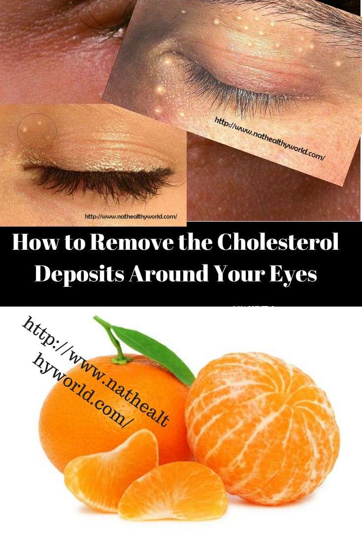 How to Remove the Cholesterol Deposits Around Your Eyes # ...