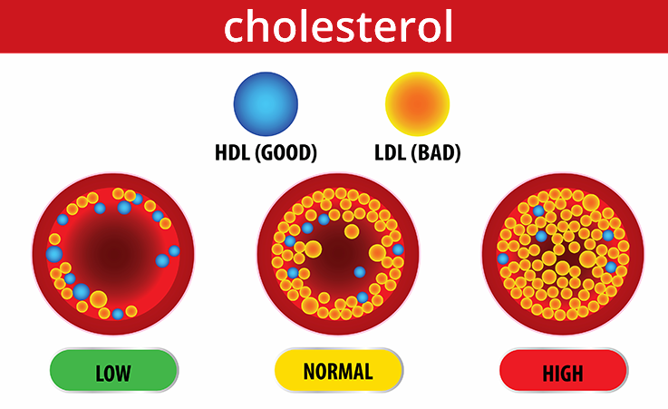 Hyperlipidemia (High Cholesterol)  YourGutt