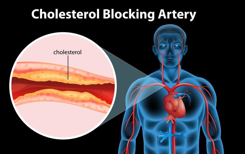 Is High Cholesterol And Heart Disease Myth Or Truth?