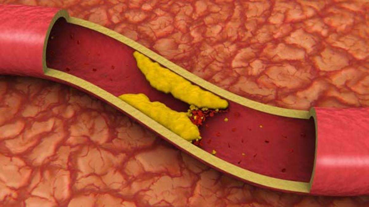 Natural Ways to Remove Arterial Plaque