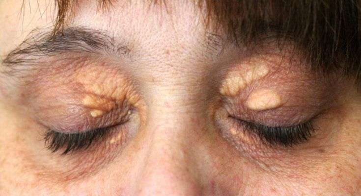 Pin on How to Remove the Cholesterol Deposits Around Your Eyes â Healslife
