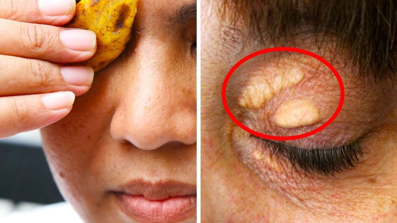 Say Goodbye To Cholesterol Deposits On Your Eyelids And Under Eyes With ...