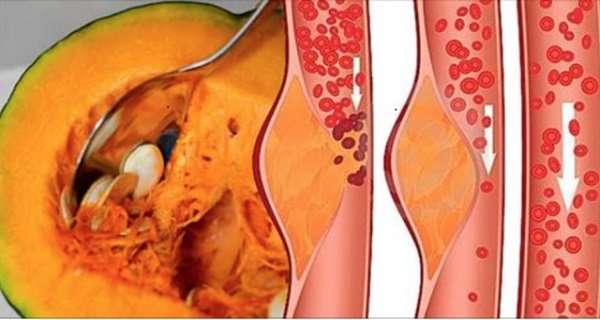 See The Natural Ways To Remove Plaque From Arteries And ...