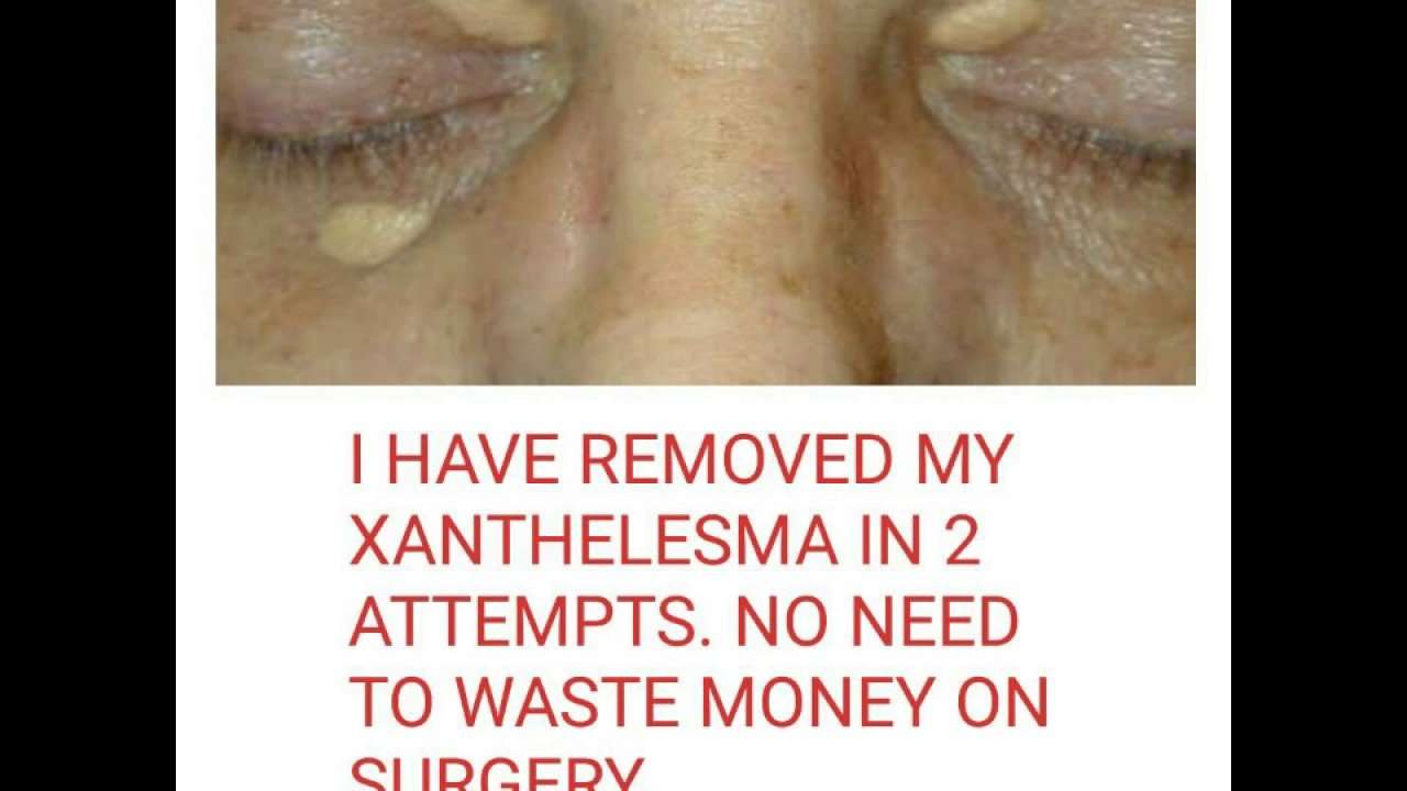 Xanthelasma removal at home